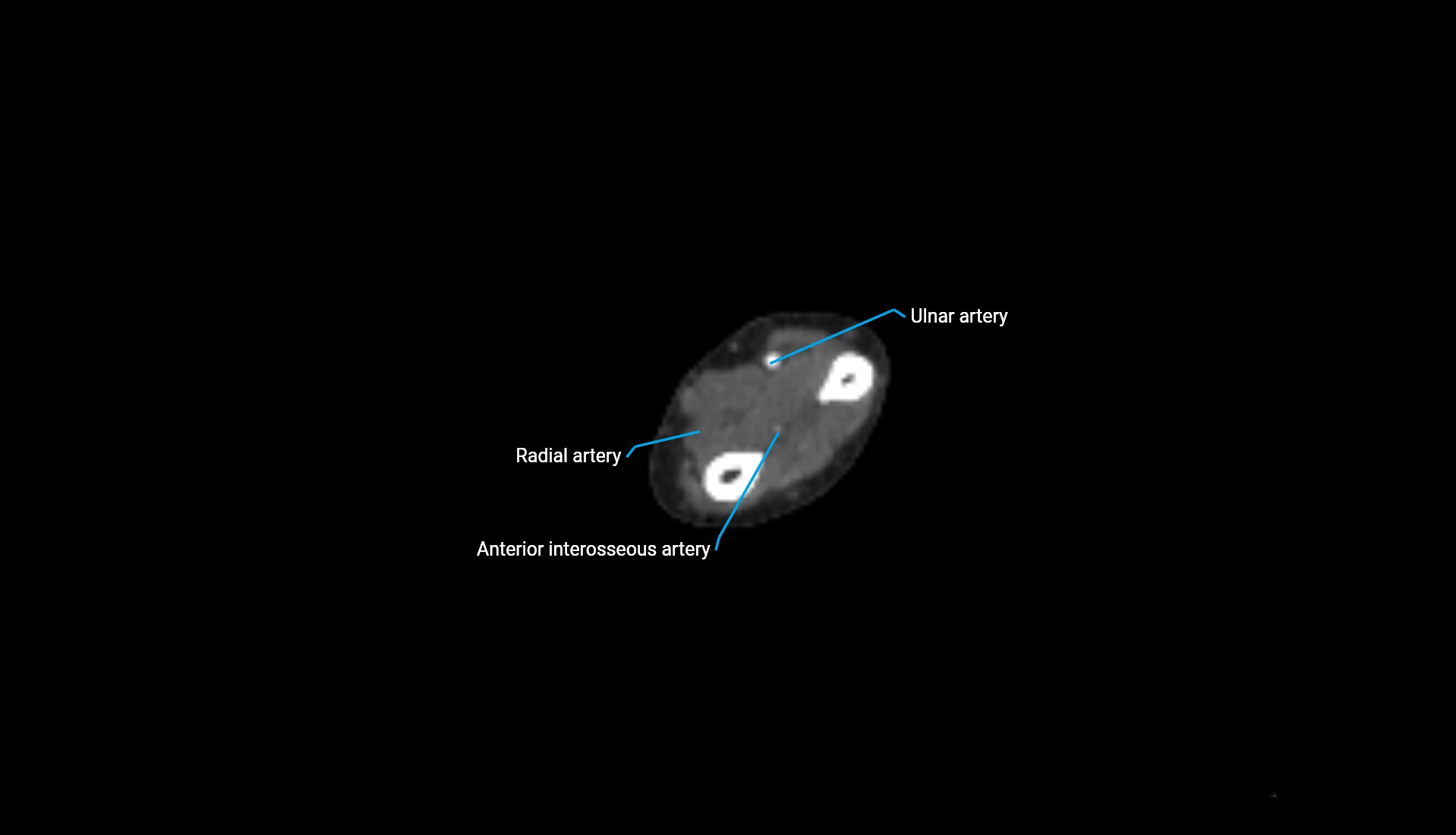 CTA upper limb axial cross sectional anatomy labelled image 115 (2).webp